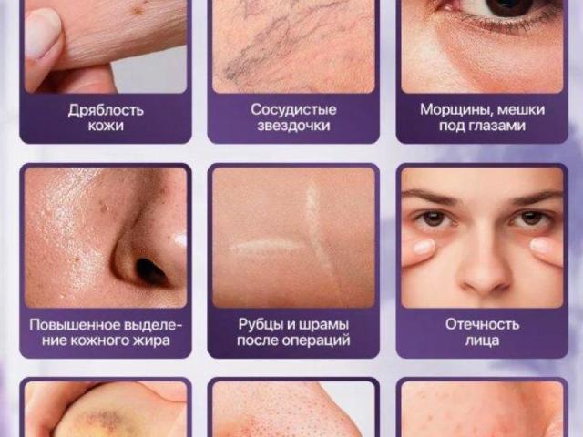 Дарсонваль Дерма Ванд (Derma Wand) - 6/12