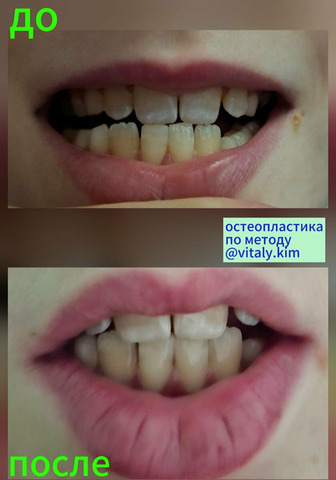 Остеопластика. Диафрагмальные практики - 4/11