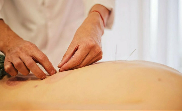 Лечение иглоукалыванием в Москве